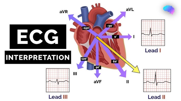 ECG Diagnosis