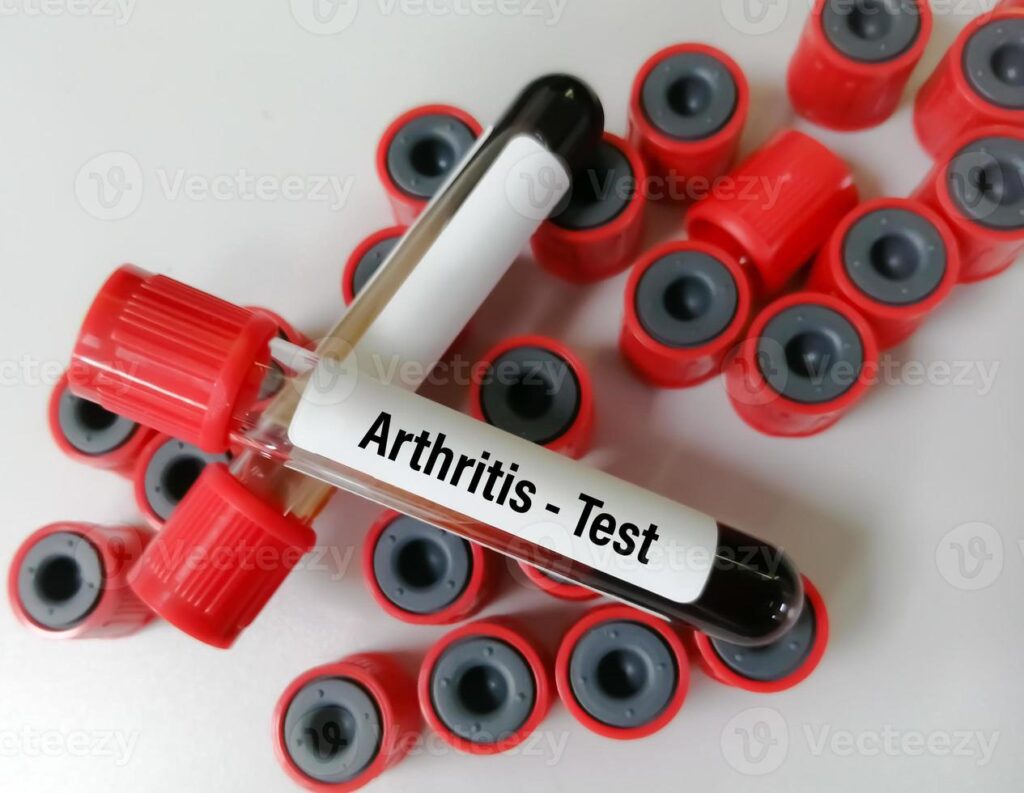blood sample tube for analysis of arthritis ra profile test in laboratory rheumatoid arthritis photo